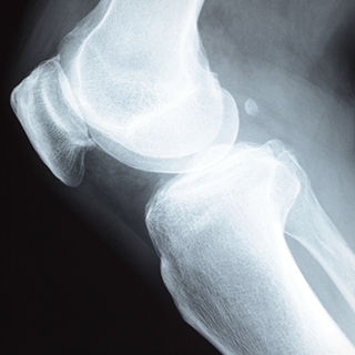 関節リウマチについて